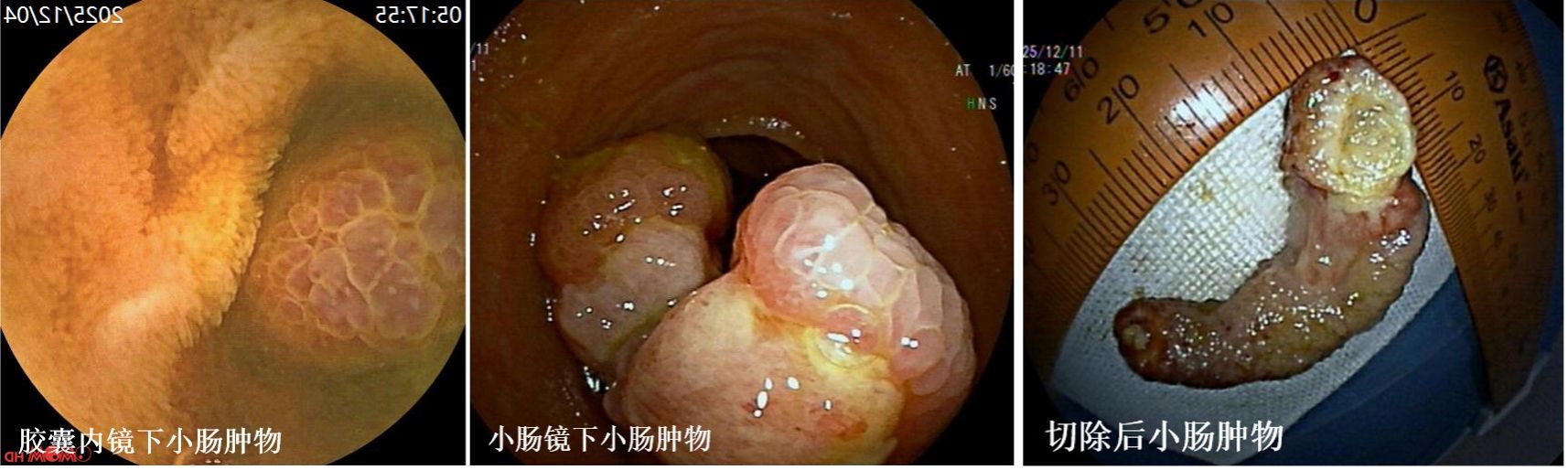 小肠翻转1.jpg 小肠翻转1.jpg