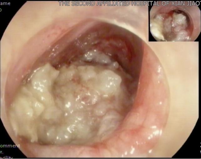 图片异物1.jpg 图片异物1.jpg