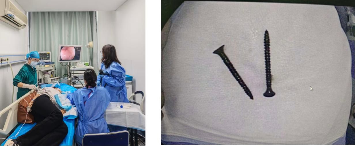 小肠镜取钉.jpg 小肠镜取钉.jpg