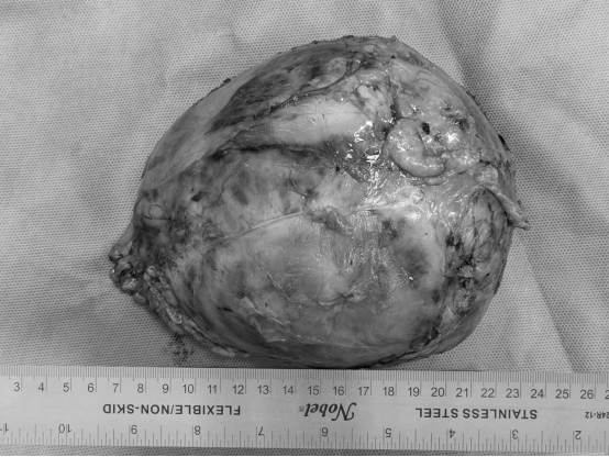 图2 肿瘤完整切除,肾脏得以保留.png