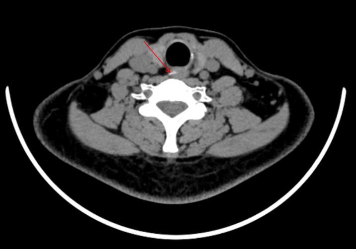 图片异物2.jpg 图片异物2.jpg