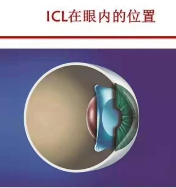 ICL眼内位置示意图_副本.jpg