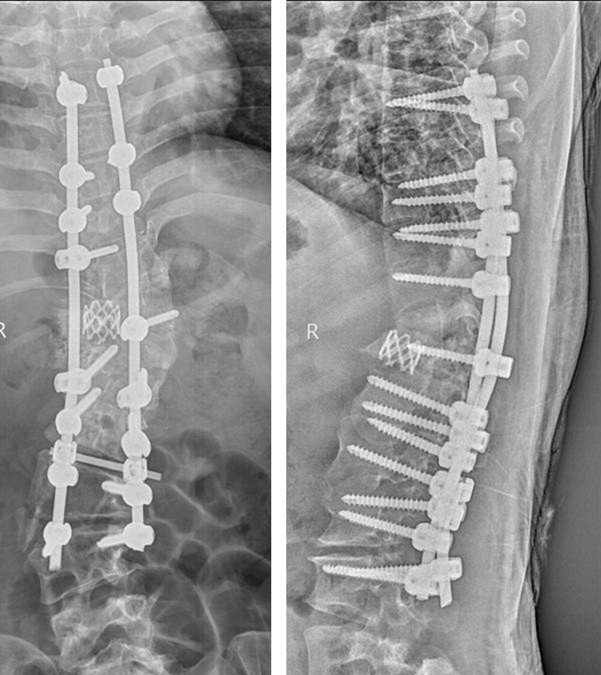 图4 术后外观照及X线正侧位_副本.jpg