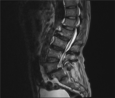 图1 腰椎MRI.jpg