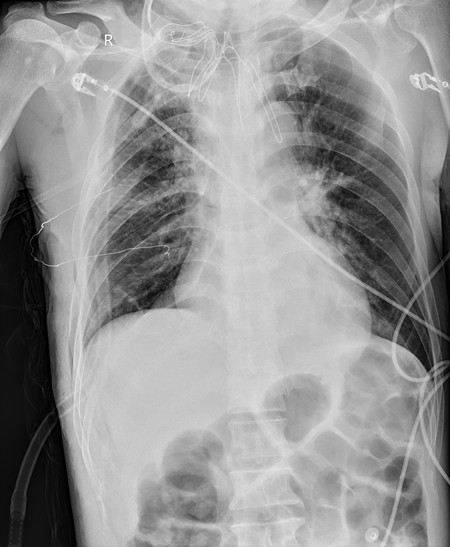 术后胸片_副本.jpg