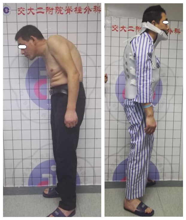 重度驼背术前_副本.jpg 重度驼背术前_副本.jpg