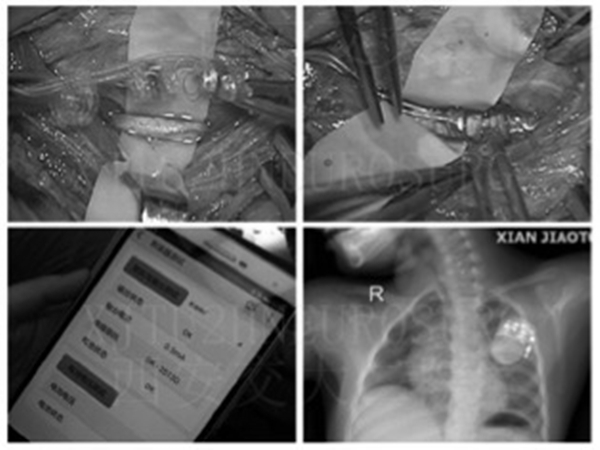 神经外科vns_副本.jpg 神经外科vns_副本.jpg