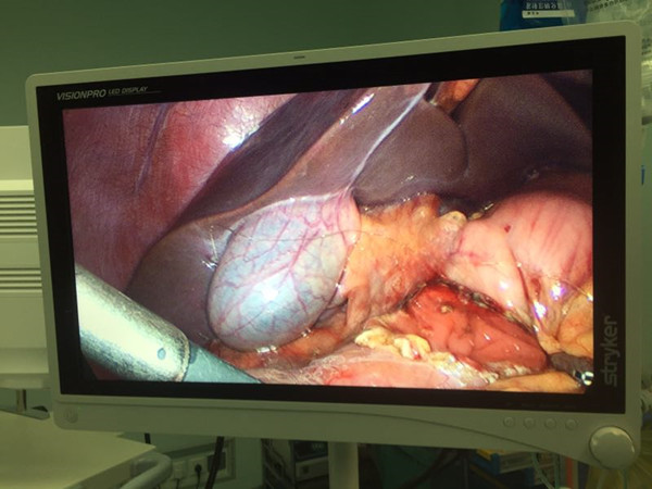 腹腔镜视图_副本.jpg
