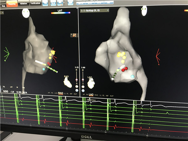 室上速三维 (1)_副本.jpg