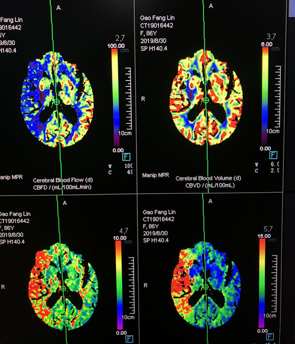 术前CTP提示右侧颈内动脉分布区血流减少_副本.jpg
