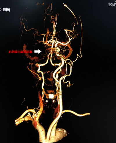 术前CTA见右侧颈内动脉闭塞_副本.jpg