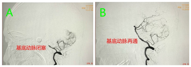 3. 图B术后造影，见基底动脉血流通畅_副本.jpg